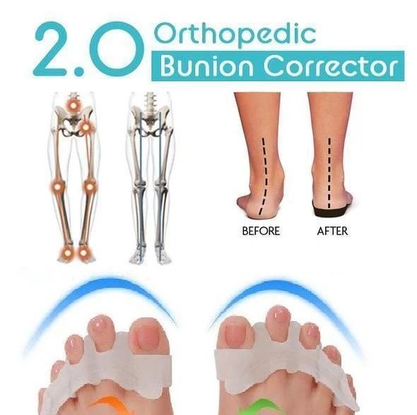 orthopedic bunion corrector 2 0